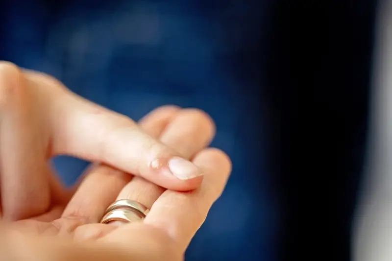 Co jest najlepsze na kurzajki?