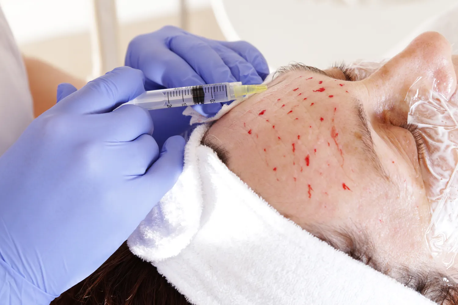 Gdzie wstrzykuje się kwas hialuronowy?