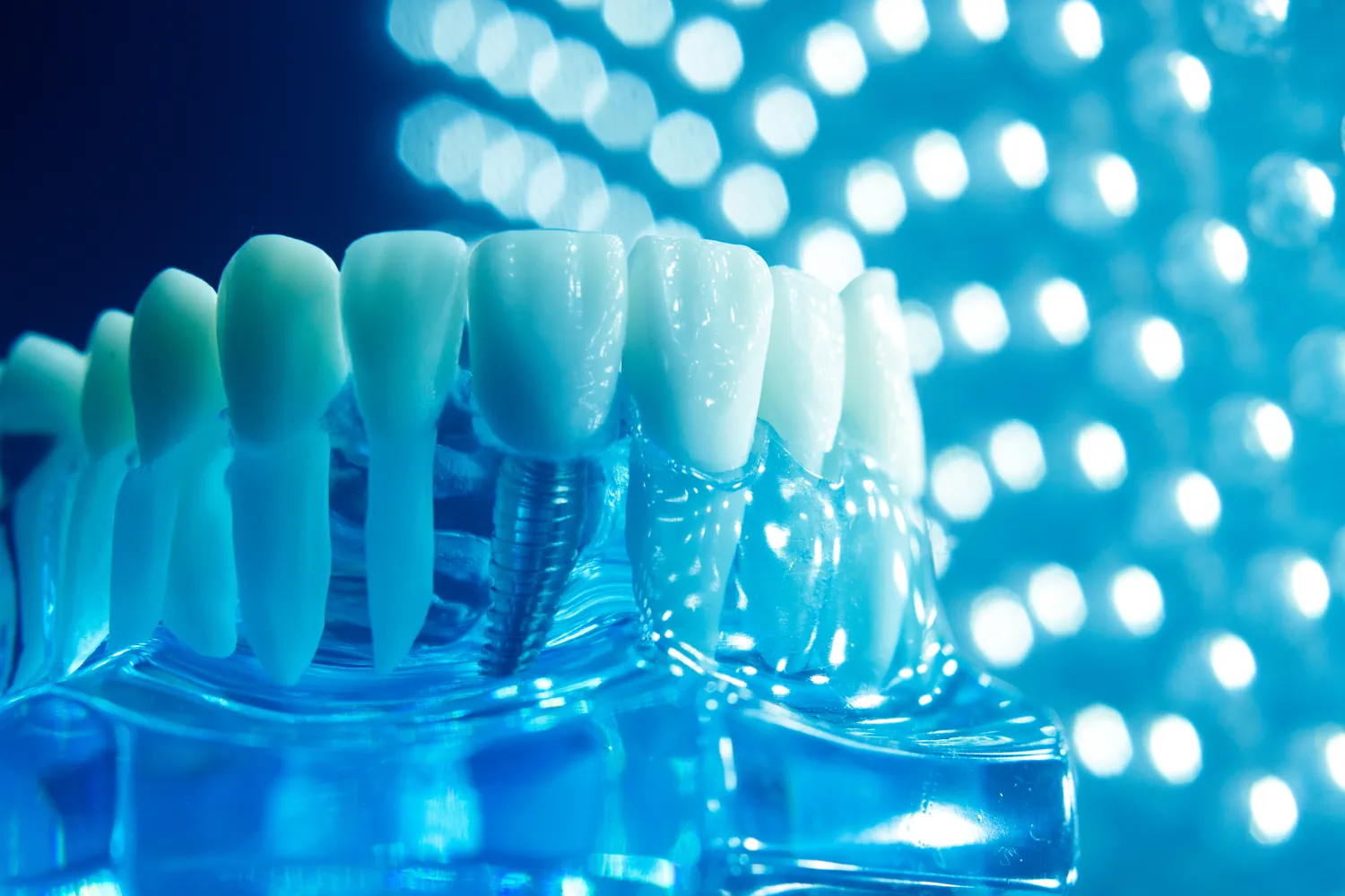 Ile kosztują zęby implanty?