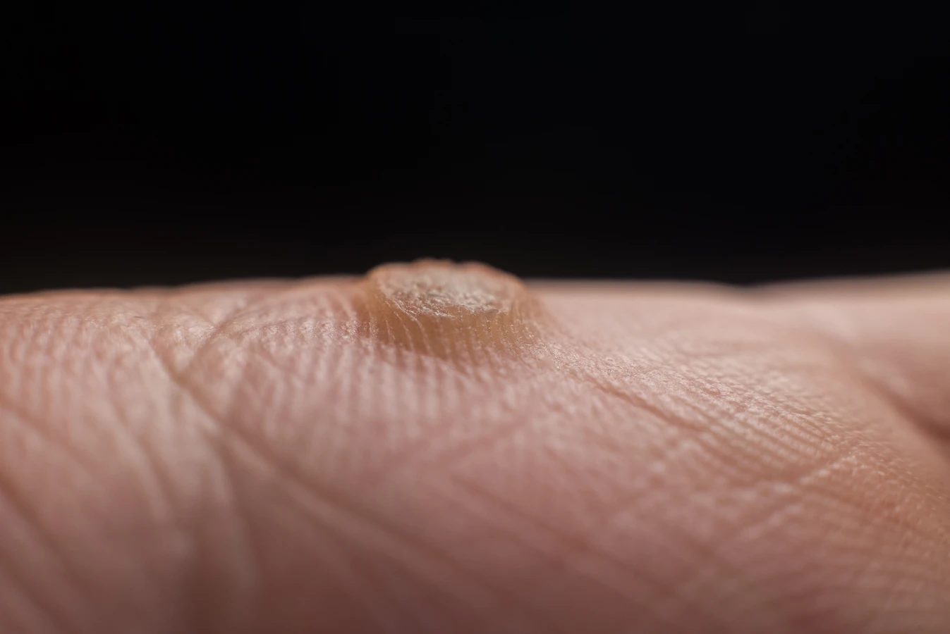 Help 4 skin kurzajki jak stosować?