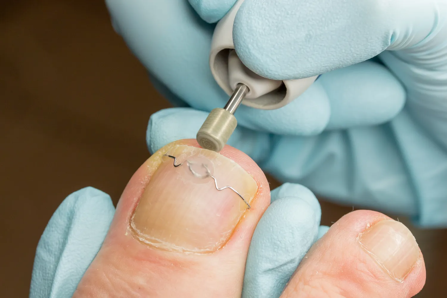 Przygotuj swoje stopy na lato – podologiczne ABC